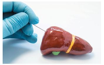 Is Liver Biopsy a Gold or an Old Standard in NAFL and NASH?